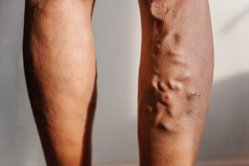 Fototapeta na wymiar Varicose veins in a woman. swelling of veins in the legs of an elderly person. clogged veins with plugs on a person's legs
