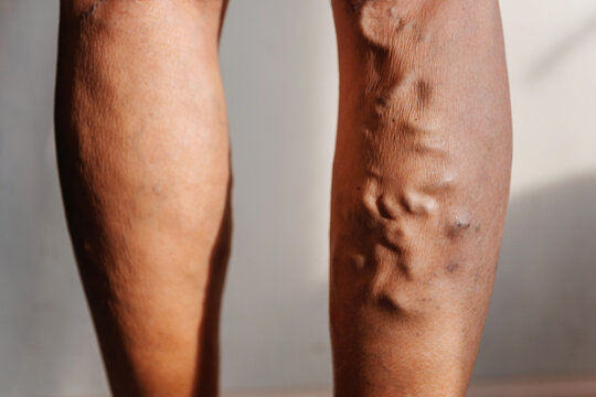 Varicose veins in a woman. swelling of veins in the legs of an elderly person. clogged veins with plugs on a person's legs