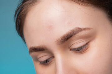 Girl with acne stick round acne patch on her cheek. Using acne patches for treatment of pimple and...