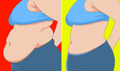 A woman's body with belly fat. Before, after. Healthcare illustration. Vector illustration.  - obrazy, fototapety, plakaty