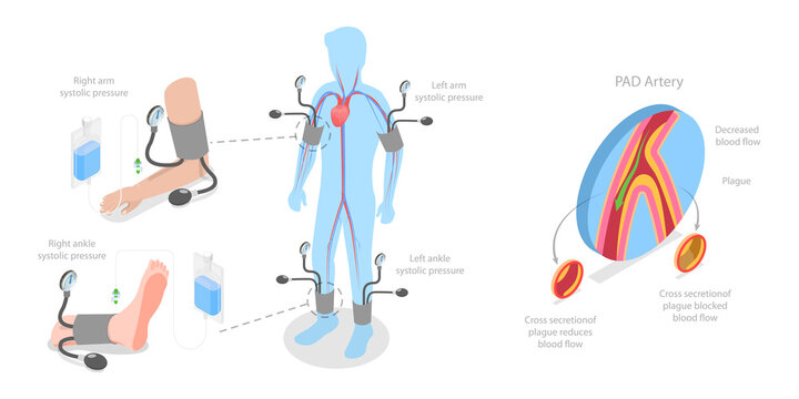 3D Isometric Flat  Illustration of ABI Test, Limb Ischemia Diagnosis