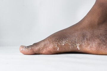 Process of foot peeling, brown skin foot in the process of peeling, skin shedding on a foot
