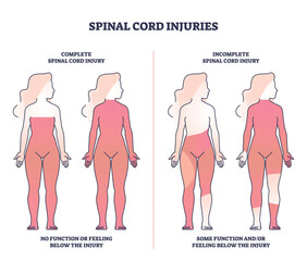 Spinal cord injuries with complete or incomplete trauma outline diagram. Labeled educational scheme with function or feeling zones in state of paralysis vector illustration. Medical neural condition.