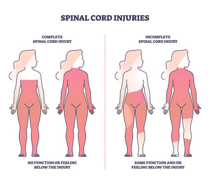 Spinal cord injuries with complete or incomplete trauma outline diagram. Labeled educational scheme with function or feeling zones in state of paralysis vector illustration. Medical neural condition.