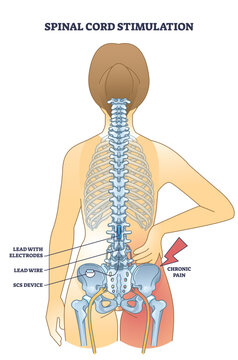 Spinal cord stimulation device for chronic back pain relief outline diagram. Labeled educational scheme with medical procedure to help patients after spinal trauma or injury vector illustration.