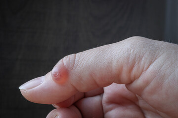 Hygroma (Ganglion cyst) of the thumb joint. Selective focus. - obrazy, fototapety, plakaty