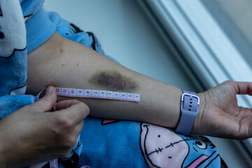 An arm bruised by the insertion and removal of a cannula used at administer medication.