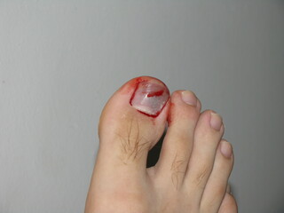 The big toe nail after being hit by a skateboard. A small amount of blood and immediant formation...