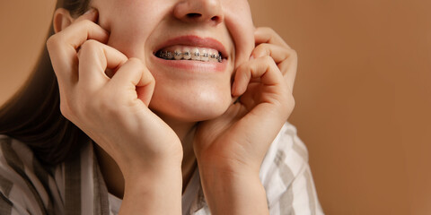 close up view braces. teenager girl show teeth on beige studio background