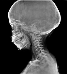 Normal film xray or radiograph of a cervical neck of a small child. Lateral view showing vertebral...