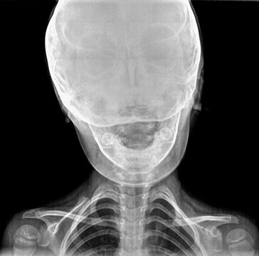 Normal film xray or radiograph of a cervical neck of a small child. AP anterior posterior view of vertebral spine, skull, teeth and non fused growth end plates of humerus head indicating a child