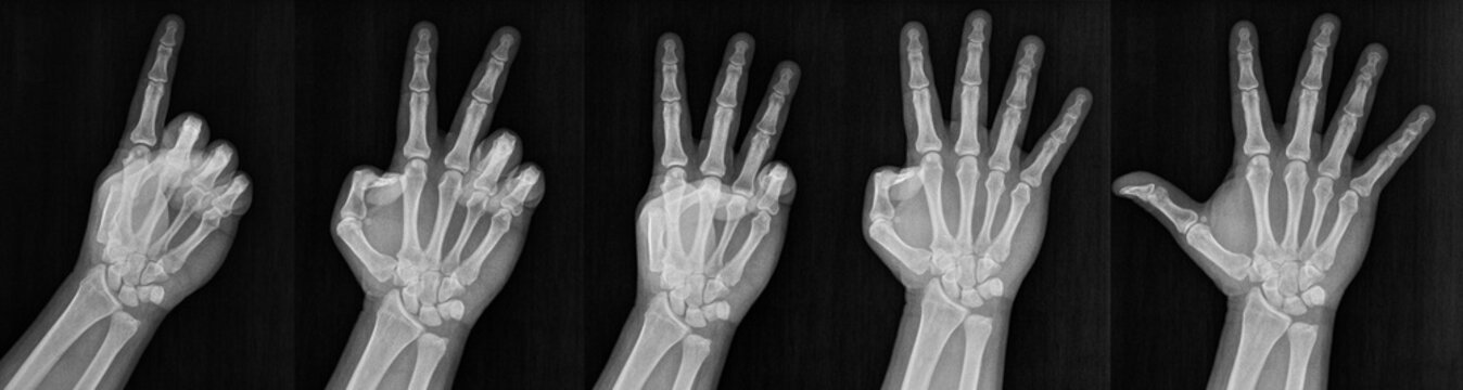 Film xray x-ray or radiograph of a hand and fingers showing the numbers one through five 1-5.  One, two, three, four five in gestural language, manual communication, or signing aka sign language