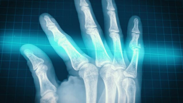 x-ray scan in progress - human hand with pinky finger  broken phalanx fracture detected. Motion graphics animation of real x ray image.