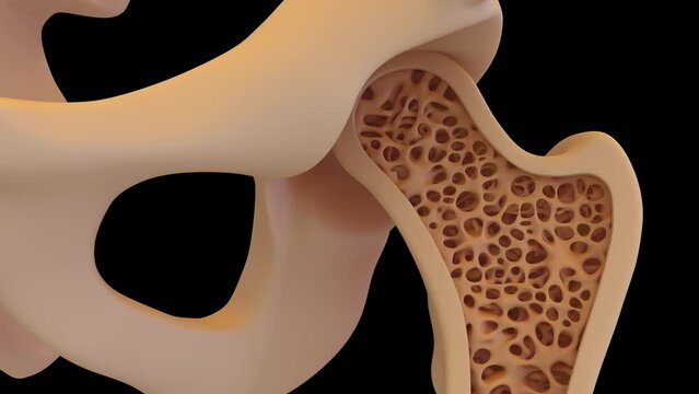 4k rendering of healthy bone structure change to osteoporosis
