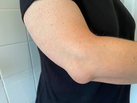 Elbow olecranon bursitis is sometimes called &ldquo;Popeye&rsquo;s elbow.&rdquo; Bursitis is a swelling of the bursitis sac here on elbow also known as tennis elbow