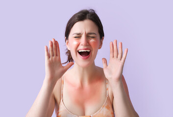 Allergic young woman with sunburned skin on lilac background, closeup