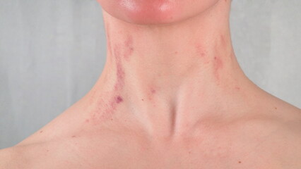 Bruised young Woman Neck. Domestic Violence Results. Traces of Violence. Protecting Women's rights Concept. No Face Photo - obrazy, fototapety, plakaty