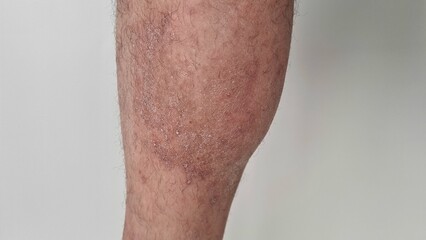 Dermatological skin disease and psoriasis on leg - obrazy, fototapety, plakaty