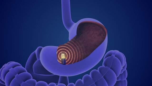 Wireless transmission and endoscopy of capsules