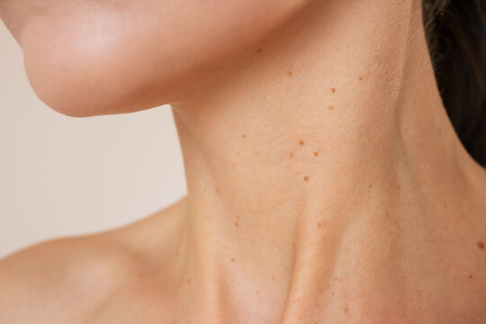close-up photo of the neck of a young woman suffering from many brown growths on the skin, papillomas, is experiencing discomfort. Skin diseases. Human papillomavirus. Laser removal of papillomas