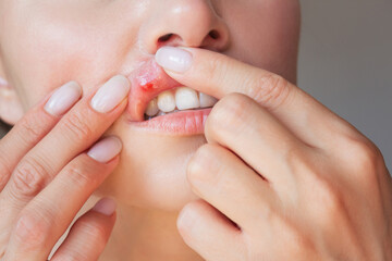 young woman suffering from stomatitis shows in close-up with both hands a stomatitis ulcer on the upper lip in the acute stage on the mucous membrane of the mouth.