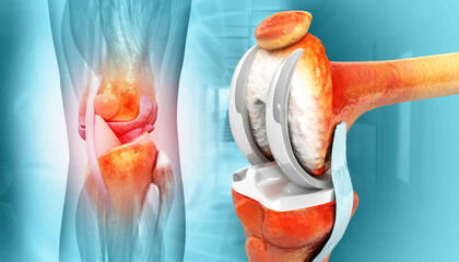Knee Joint Replacement Surgery. 3d illustration