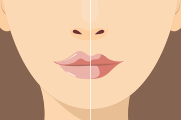 Lip augmentation and correction. Lip filler injections. Hyaluronic acid. Cosmetology procedure in a beauty salon - obrazy, fototapety, plakaty