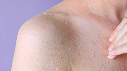 Problematic dry skin on shoulder close-up front view flaking as consequence of dry skin dehydration and dermatitis, concept of health problem dry skin and personal hygiene self care