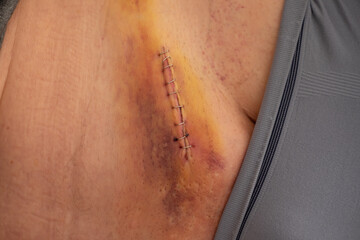 Nine staples to the groin scar on the body of an elderly gentleman after an inguinal hernia operation - obrazy, fototapety, plakaty