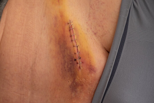 Nine staples to the groin scar on the body of an elderly gentleman after an inguinal hernia operation
