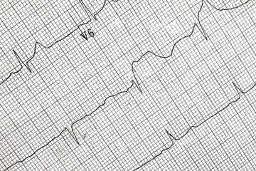 EKG graph showing heart activity