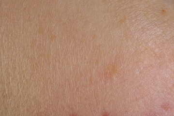 Texture of skin with birthmarks as background, macro view