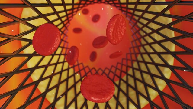 Aided by the metallic scaffolding of a stent, tiny red blood cells weave their way through the labyrinthine network of a blood vessel, 3d rendering