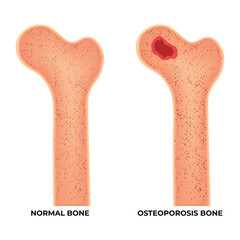 Normal Bone and Osteoporosis Bone Science Design Vector Illustration
