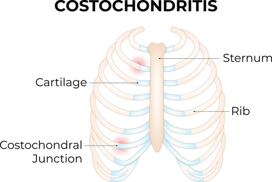 Costochondritis Science Design Vector Illustration