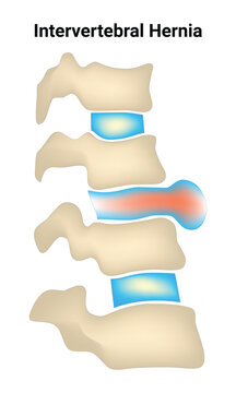 Intervertebral Hernia Science Design Vector Illustration