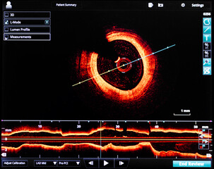 optical coherence tomography oct image angiography catheter lab atherosclerosis, computer screen...