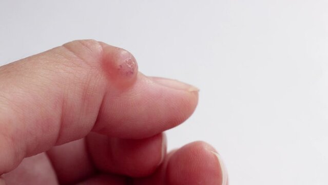 Hygroma filled with gel-like fluid from the joint. Selective focus.