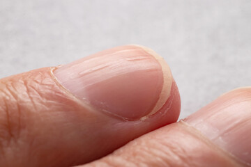 Ridged fingernails with vertical ridges.Nails problems