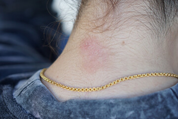 Allergic skin on neck wears gold necklace. A skin disorder of atopic dermatitis. Concept, health problems. Itchy and irritation or infection.                