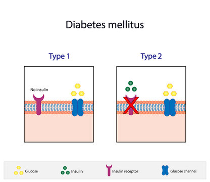 Diabetes mellitus type 1, pancreas's failure to produce enough insulin and type 2, cells fail to respond to insulin (Insulin resistance). Result in high blood glucose levels. Vector illustration.