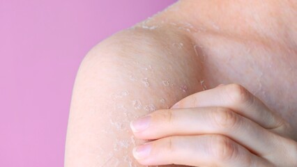 Skin is peeling shoulder with peeling skin close-up front view skin problems dry skin consequences of dehydration and dermatitis self care, concept of body and cosmetology hygiene and medicine