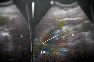 Left kidney is of normal size, normal cortical thickness and echopattern with good cortico medullary differentiation, no stones, cysts, mild fullness of left renal pelvis likely residual