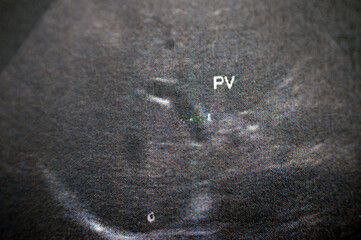 Portal vein is seen patent with normal caliber 9 mm within a pelvi abdominal ultrasound for a female patient, selective focus