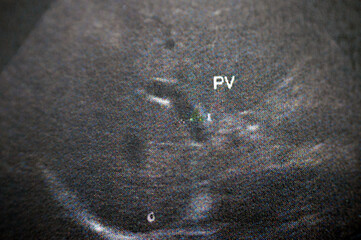 Portal vein is seen patent with normal caliber 9 mm within a pelvi abdominal ultrasound for a...