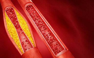 Hyperlipidemia or arteriosclerosis. Blocked artery concept and human blood vessel as a disease with cholesterol fat buildup clogging. Clogged arteries, Cholesterol plaque in the artery. 3D Rendering - obrazy, fototapety, plakaty