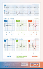 When analyzing the nature of the wide QRS complex, some indicators can be used in different ECG leads, although the analysis does not always achieve 100% diagnostic accuracy.