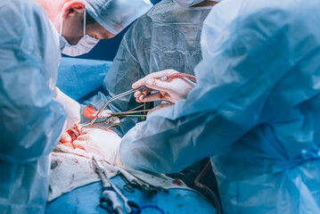 A highly qualified team of surgeons performs a complex operation to remove a pancreatic cyst using...