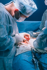 A highly qualified team of surgeons performs a complex operation to remove a pancreatic cyst using medical instruments
