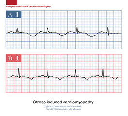Naklejka premium Male, 57 years old, was admitted to hospital with traumatic subarachnoid hemorrhage. ECG shows significant repolarization abnormalities and is thought to be due to stress cardiomyopathy.